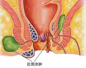 南宁治疗肛周脓肿的好医院