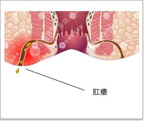 肛瘘怎么治疗好