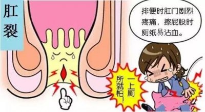 治疗肛裂大概需要多少钱