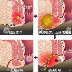 肛门疼痛是怎么引起的，治疗起来贵吗？