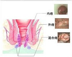 治疗痔疮为什么选南宁医博？